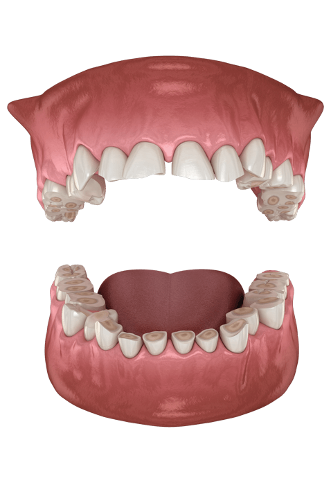 Atrición dental (bruxismo) que provoca la pérdida de tejido dental. Ilustración dental en 3D