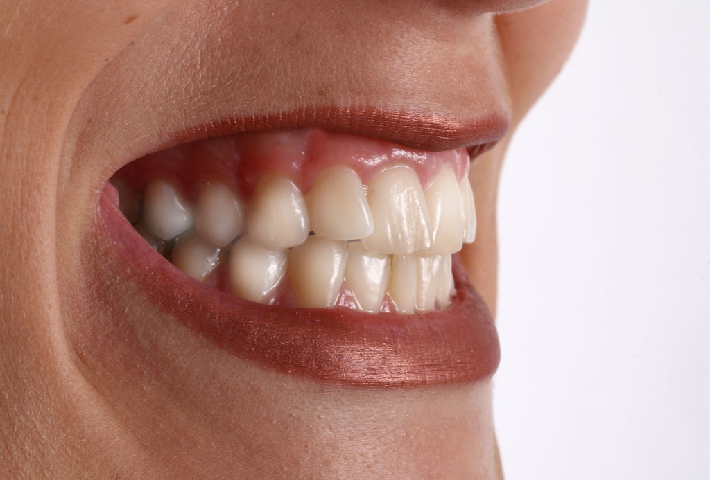 Rechinamiento de dientes