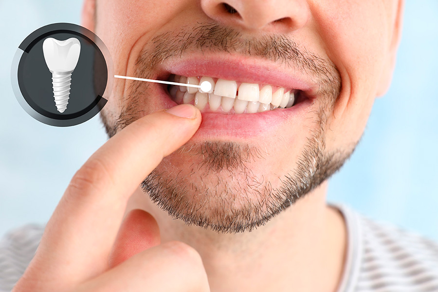 Beneficios implante dental