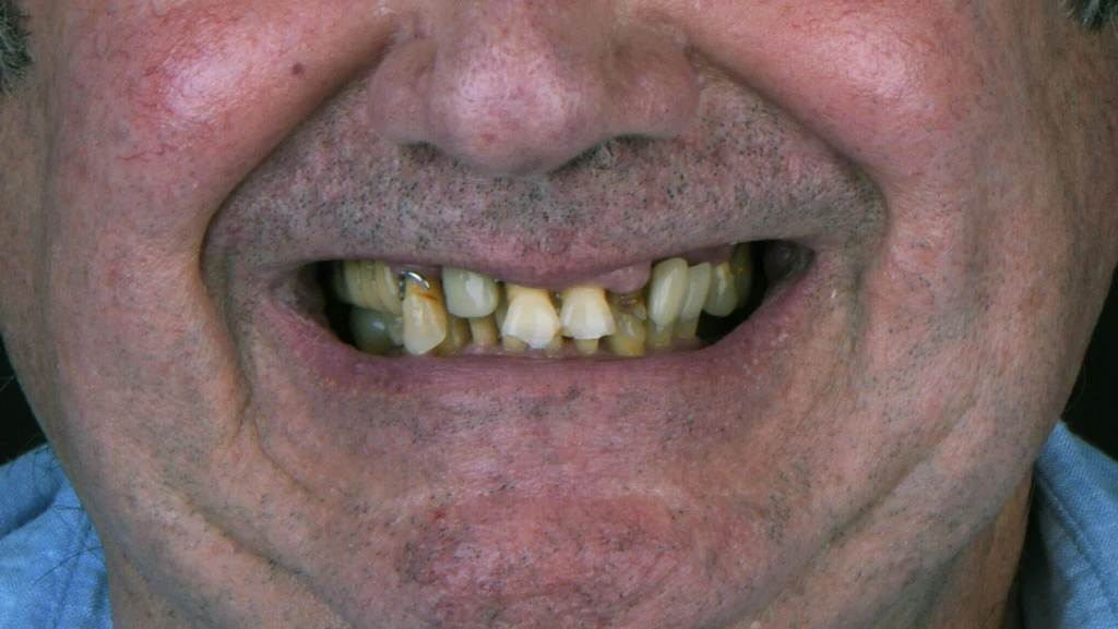Caso de implantes antes