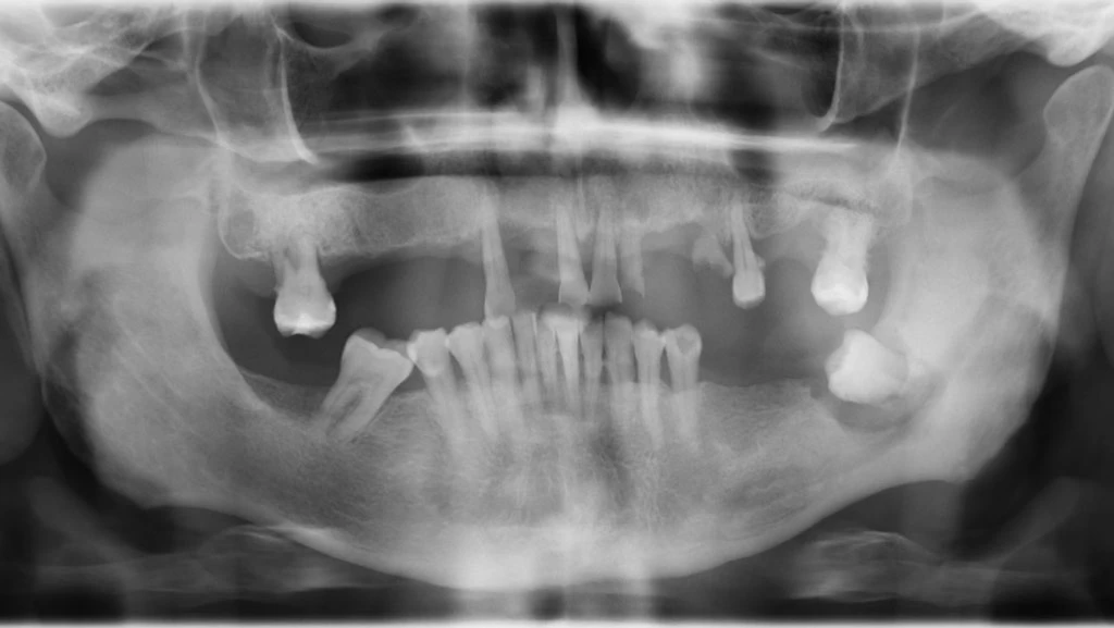 Radiografía caso de implantes antes