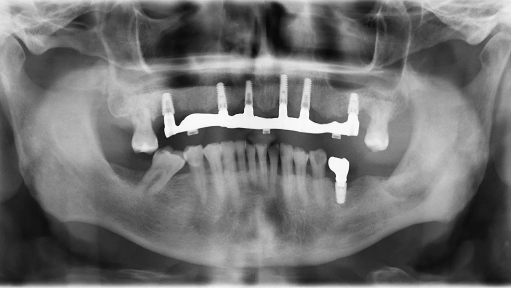 Radiografía caso de implantes después
